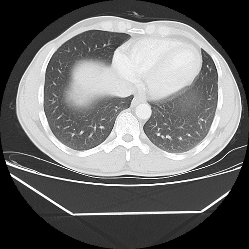 Aneurysmal bone cyst - rib (Radiopaedia 82167-96220 Axial lung window 48).jpg