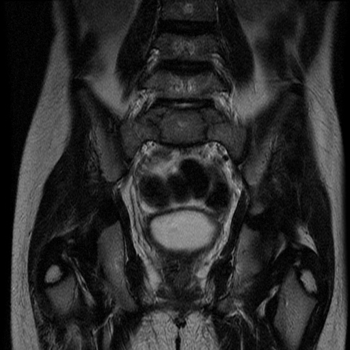 File:Aneurysmal bone cyst - sacrum (Radiopaedia 65190-74196 Coronal T2 15).jpg