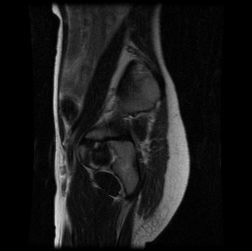 File:Aneurysmal bone cyst - sacrum (Radiopaedia 65190-74196 Sagittal T2 25).jpg