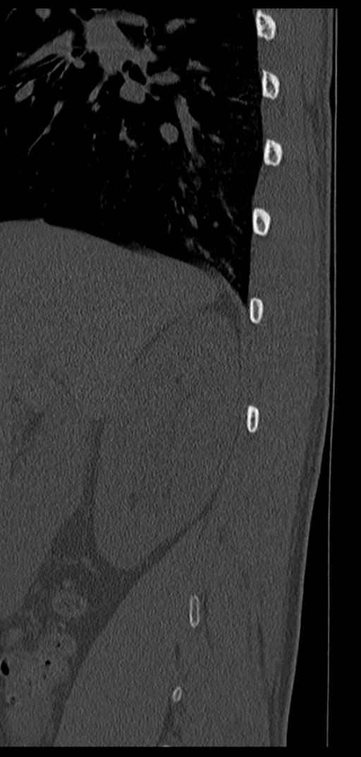 Aneurysmal bone cyst T11 (Radiopaedia 29294-29721 Sagittal bone window 74).jpg