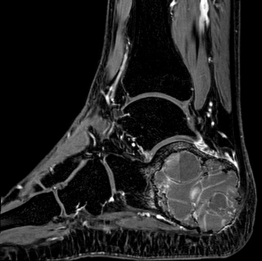 File:Aneurysmal bone cyst of the calcaneus (Radiopaedia 60669-68420 F 21).jpg