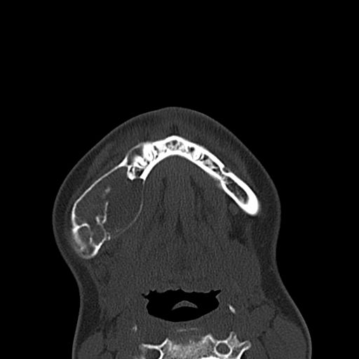 Aneurysmal bone cyst of the mandible (Radiopaedia 43280-46601 Axial bone window 12).jpg