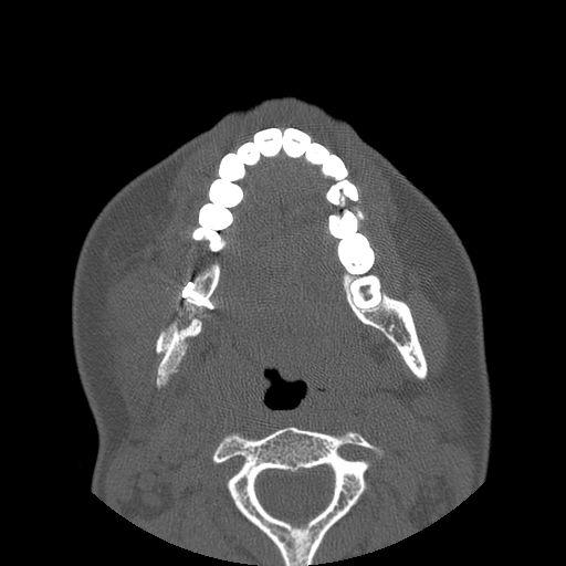 Aneurysmal bone cyst of the mandible (Radiopaedia 43280-46823 Axial bone window 63).jpg
