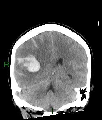 Aneurysmal subarachnoid hemorrhage with intra-axial extension (Radiopaedia 84371-99699 Coronal non-contrast 28).jpg