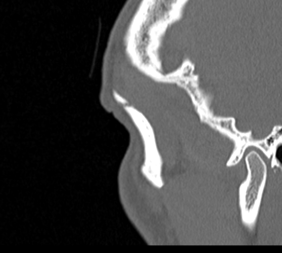 Angular epidermoid cyst (Radiopaedia 46908-51439 Sagittal bone window 96).png