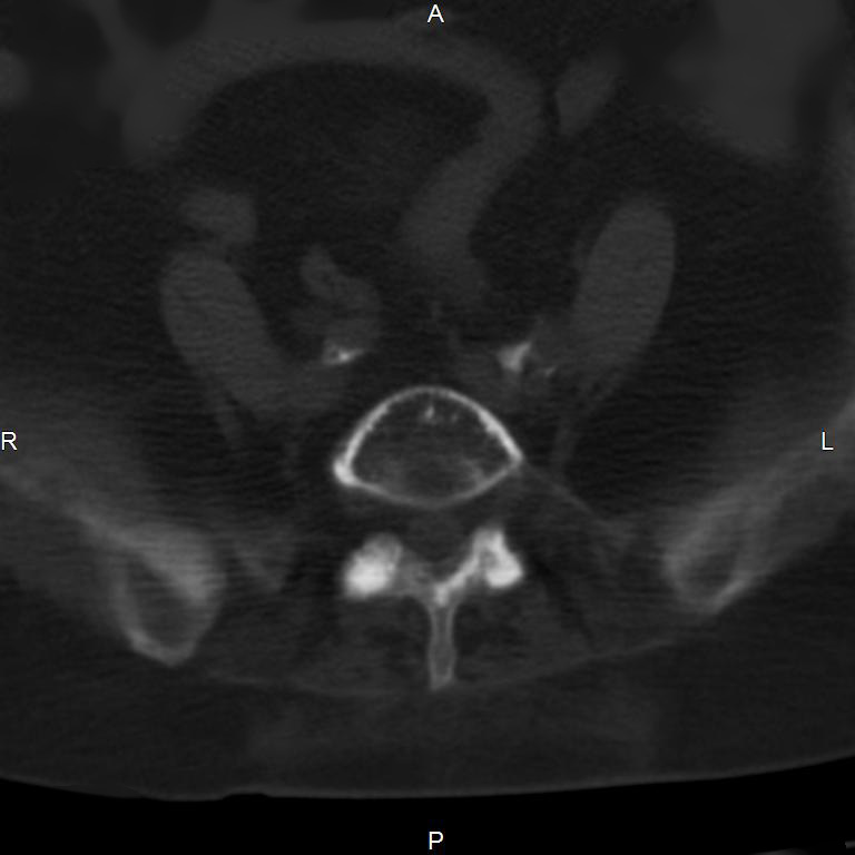 Ankylosing spondylitis (Radiopaedia 8748-9556 Axial bone window 46).jpg