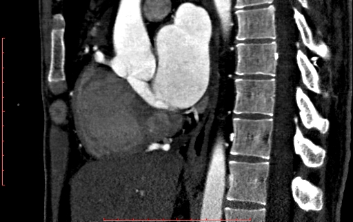 File:Anomalous left coronary artery from the pulmonary artery (ALCAPA) (Radiopaedia 70148-80181 C 111).jpg