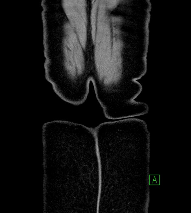 Anterior abdominal wall CSF pseudocyst (CSFoma) (Radiopaedia 79453-92571 B 55).jpg