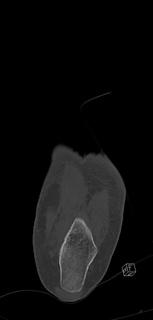 Anterior calcaneal process fracture (Radiopaedia 63353-71943 Coronal bone window 40).jpg