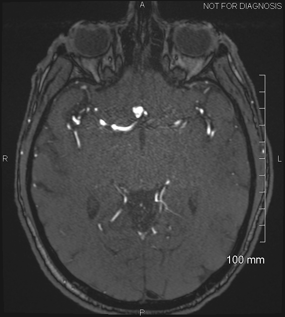 Anterior cerebral artery aneurysm (Radiopaedia 80683-94127 Axial MRA 108).jpg