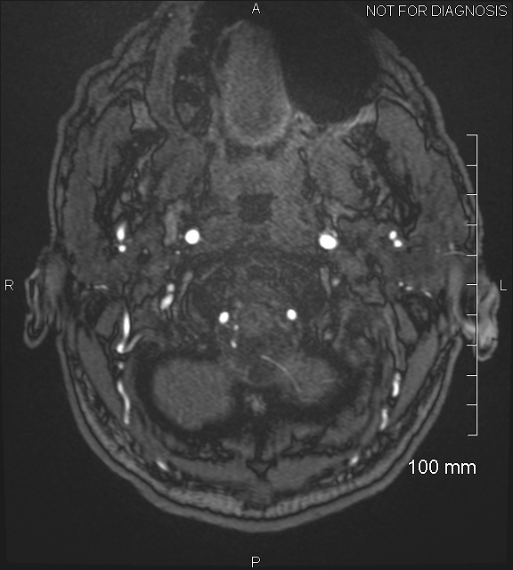 Anterior cerebral artery aneurysm (Radiopaedia 80683-94127 Axial MRA 4).jpg