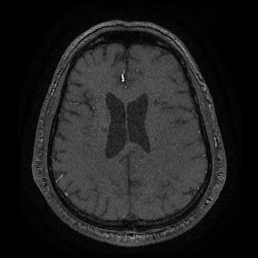 Anterior cerebral artery infarction (Radiopaedia 46794-51323 Axial MRA 150).jpg
