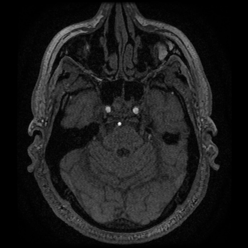 Anterior cerebral artery infarction (Radiopaedia 46794-51323 Axial MRA 41).jpg