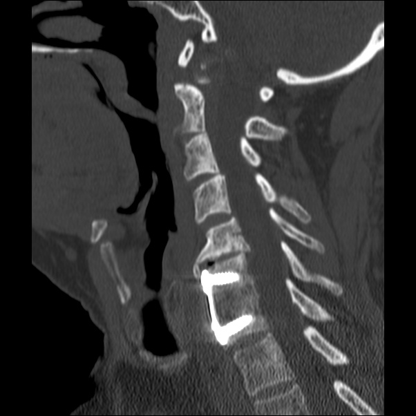 Anterior cervical postdiscectomy arthrodesis (Radiopaedia 32678-33646 Sagittal bone window 44).jpg