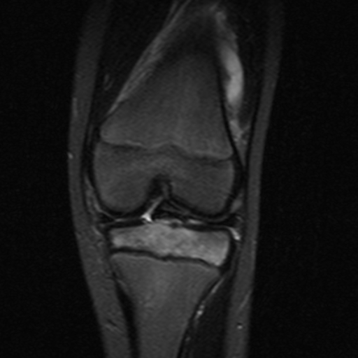 File:Anterior cruciate ligament avulsion fracture (Radiopaedia 24710-24974 Coronal STIR 6).jpg