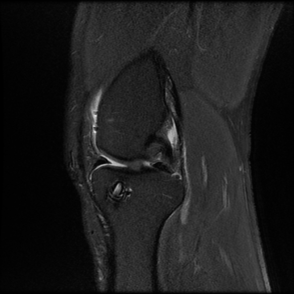 File:Anterior cruciate ligament graft tear and bucket-handle tear of medial meniscus (Radiopaedia 75867-87254 Sagittal PD fat sat 11).jpg