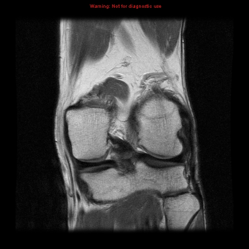 File:Anterior cruciate ligament injury - partial thickness tear (Radiopaedia 12176-12515 Coronal PD 13).jpg