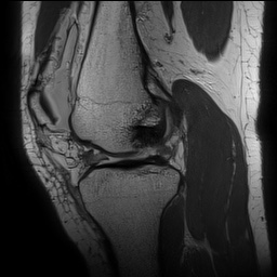 Anterior cruciate ligament rupture with Segond fracture (Radiopaedia 69043-78806 Sagittal PD 79).jpg
