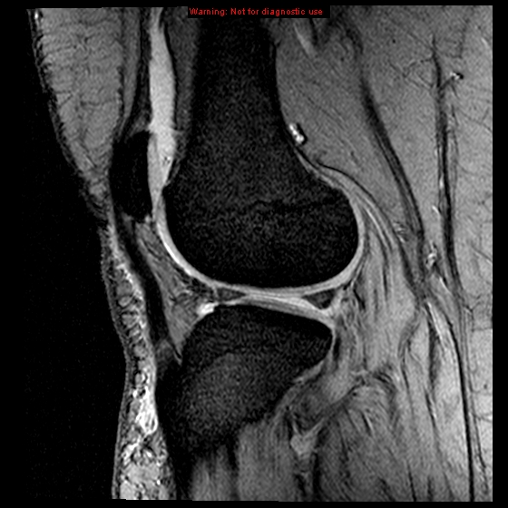 File:Anterior cruciate ligament tear (Radiopaedia 12329-12612 A 6).jpg