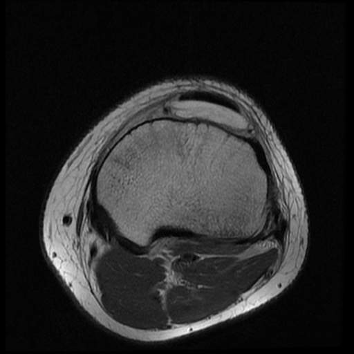 File:Anterior cruciate ligament tear (Radiopaedia 61500-69462 Axial PD 17).jpg