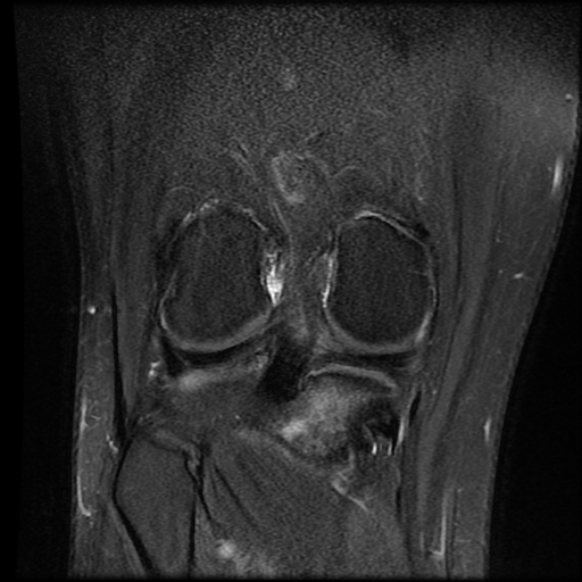 File:Anterior cruciate ligament tear with posteromedial corner injury, bucket-handle meniscal tear and chondral delamination (Radiopaedia 75501-86744 Coronal PD fat sat 19).jpg