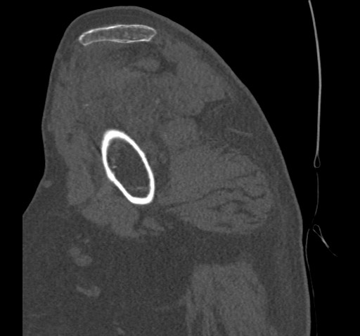 Anterior glenohumeral dislocation with Hill-Sachs lesion (Radiopaedia 62877-71249 Sagittal bone window 23).jpg