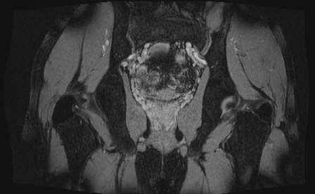Anterior inferior iliac spine avulsion fracture (Radiopaedia 81312-95000 G 17).jpg