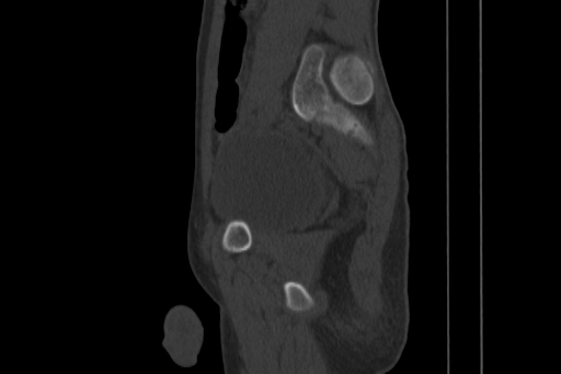 Anterior inferior iliac spine avulsion injury (Radiopaedia 88666-105376 Sagittal bone window 63).jpg
