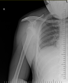 File:Anterior shoulder dislocation (Radiopaedia 26999).png