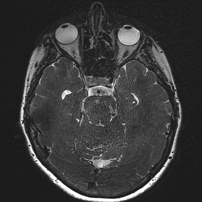 Anterior temporal encephalocele (Radiopaedia 82624-96808 Axial T2 high res 72).jpg