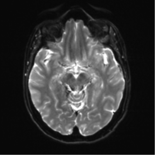 Anterior temporal lobe perivascular space (Radiopaedia 40946-43650 Axial DWI 11).png