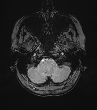 File:Anterior temporal lobe perivascular space (Radiopaedia 40946-43650 Axial SWI 10).png