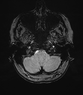 File:Anterior temporal lobe perivascular space (Radiopaedia 40946-43650 Axial SWI 11).png