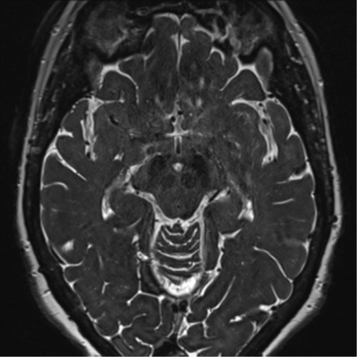 Anterior temporal pole cysts (Radiopaedia 46629-51102 Axial 58).png