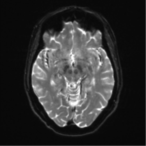 Anterior temporal pole cysts (Radiopaedia 46629-51102 Axial DWI 12).png