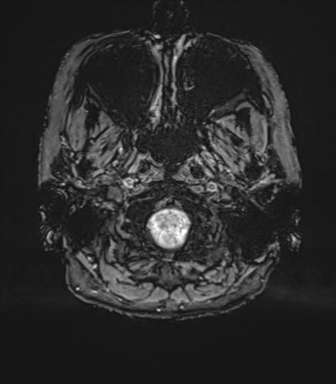 Anterior temporal pole cysts (Radiopaedia 46629-51102 Axial SWI 7).png