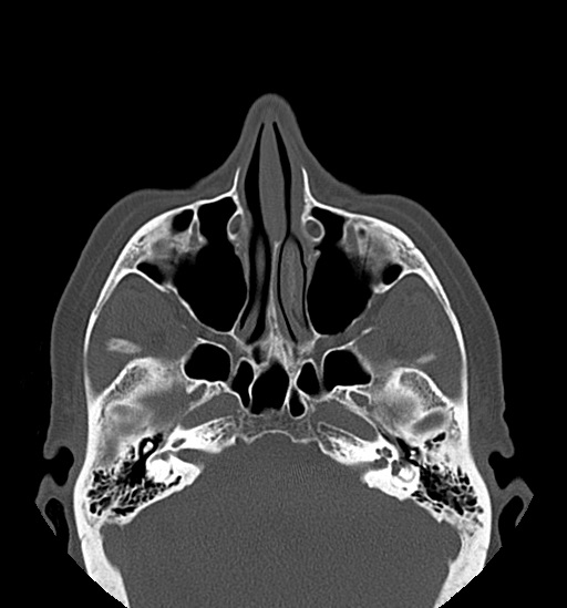 Anterior temporomandibular joint dislocation (Radiopaedia 59430-66784 Axial non-contrast 11).jpg