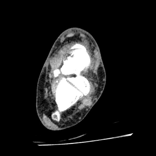 Anterior tibial artery false aneurysm (Radiopaedia 88984-105809 A 153).jpg