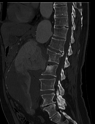 File:Anterior vertebral scalloping (abdominal aortic aneurysm) (Radiopaedia 66744-76067 Sagittal bone window 28).jpg