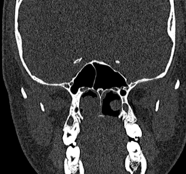 Antrochoanal polyp (Radiopaedia 30002-30554 Coronal bone window 58).jpg