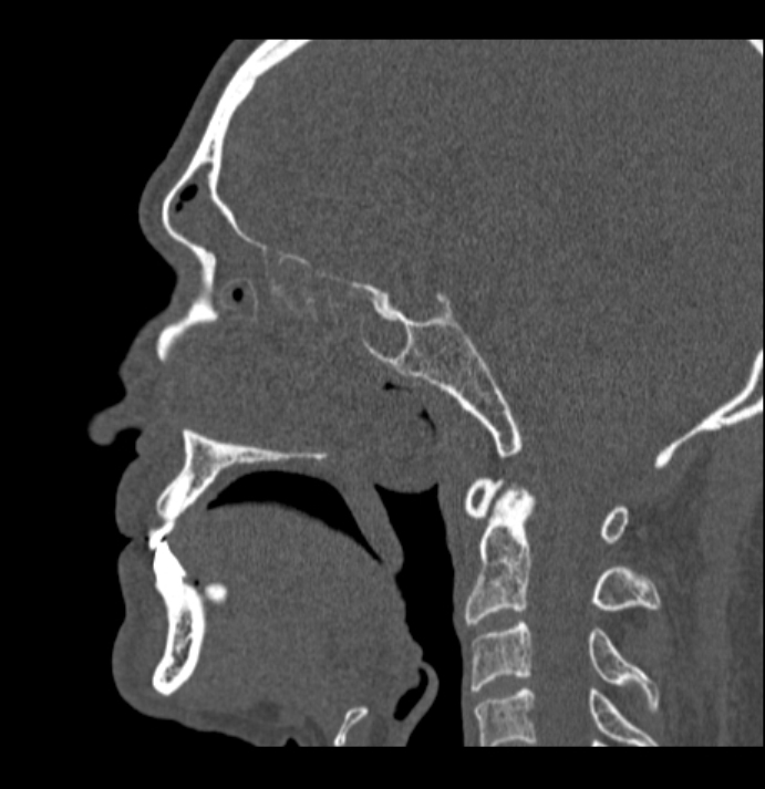 Antrochoanal polyp (Radiopaedia 79011-92169 Sagittal bone window 23).jpg