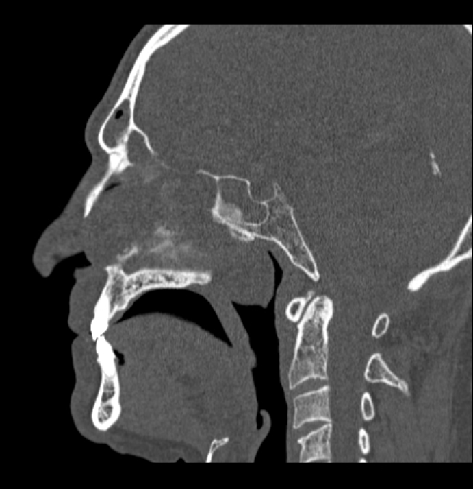 Antrochoanal polyp (Radiopaedia 79011-92169 Sagittal bone window 29).jpg