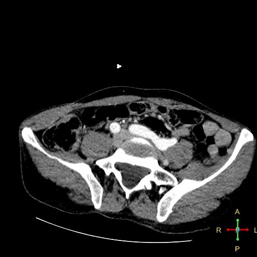 File:Aortic aneurysm and penetrating ulcer (Radiopaedia 23590-23704 A 40).jpg