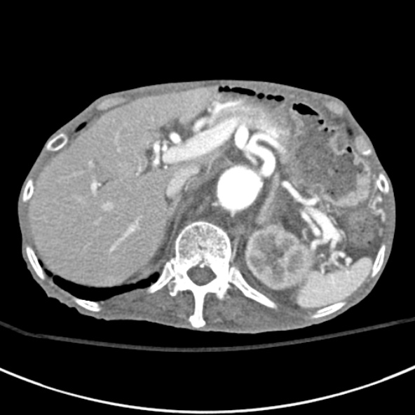 File:Aortic aneurysm with spinal destruction (Radiopaedia 42301-45410 A 23).jpg