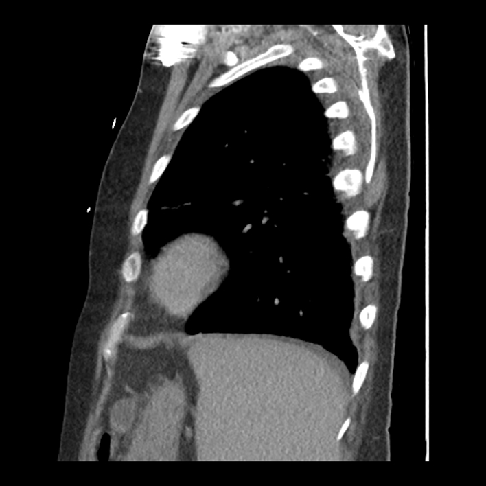 Aortic arch graft infection (FDG PET-CT) (Radiopaedia 71975-82437 C 55).jpg