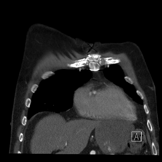 Aortic dissection (CTPA) (Radiopaedia 75506-86750 B 13).jpg