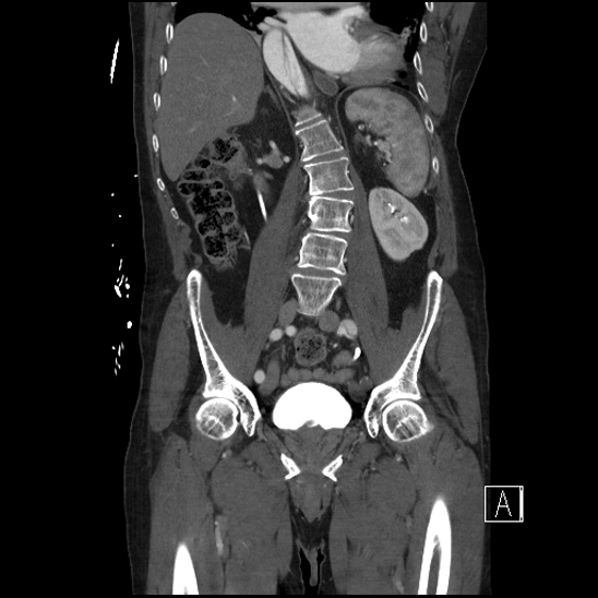 File:Aortic dissection (CTPA) (Radiopaedia 75506-86750 F 41).jpg