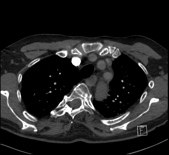 File:Aortic dissection (CTPA) (Radiopaedia 75506-86751 Axial C+ CTPA 32).jpg