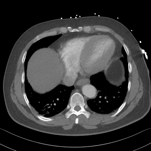 File:Aortic dissection (Radiopaedia 50763-56234 A 54).png