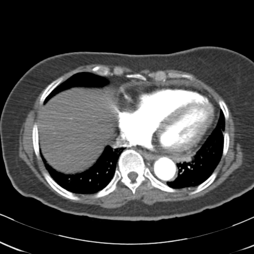File:Aortic dissection - Stanford type A (Radiopaedia 39073-41259 A 57).png